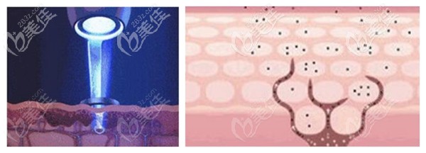 科医能整形祛斑原理 科医能整形祛斑原理