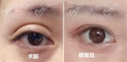 双眼皮外折改内折案例图