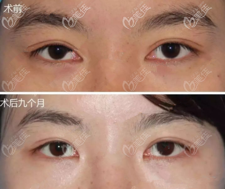 外折平行改内折扇形案例