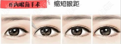 开内眼角的作用