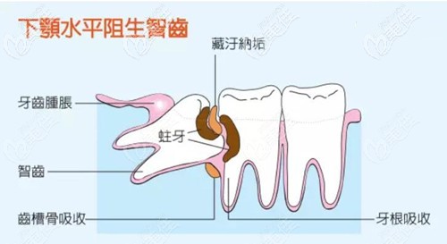 牙槽骨吸收的原因