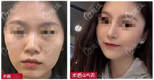 王德宁隆鼻案例