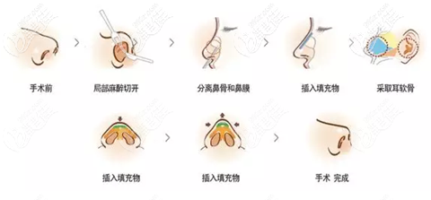 王德宁医生耳软骨隆鼻手术过程