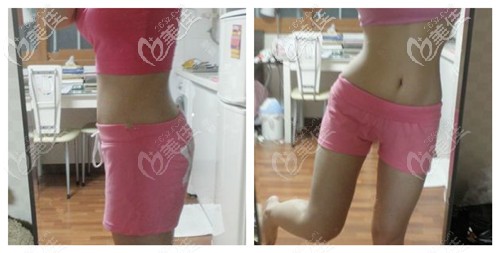 现在回头看看我到驻马店缔莱美做肚子吸脂前的照片，简直不忍直视！