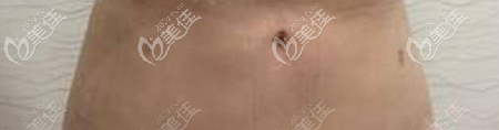 腰腹吸脂后的针眼大小
