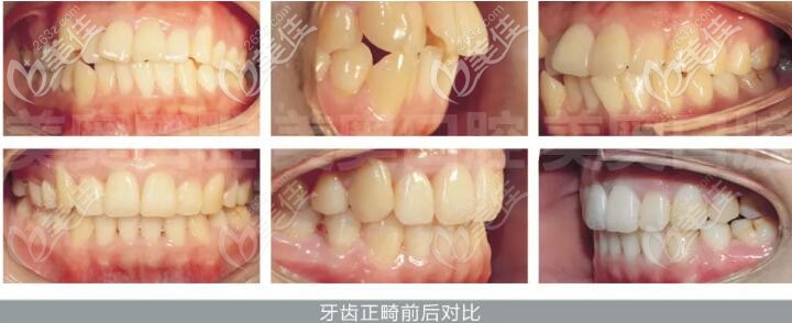 牙齿拥挤、前突、拔除4颗前磨牙后，在南京美奥戴上国产的正雅矫治器进行正畸