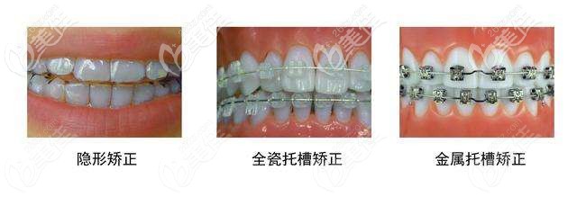 常用的牙齿矫正器 常用的牙齿矫正器
