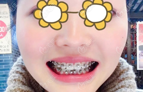 戴牙套间隙拍照留念