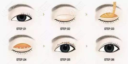 全切双眼皮流程 全切双眼皮流程