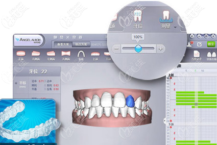 德国正畸软件模拟影像