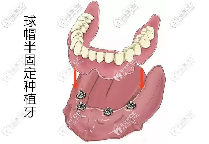 全口半固定种植牙 全口半固定种植牙