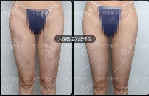 王东大腿抽脂修复案例