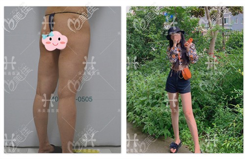 任学会大腿吸脂修复案例