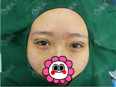 做完埋线双眼皮手术即刻照