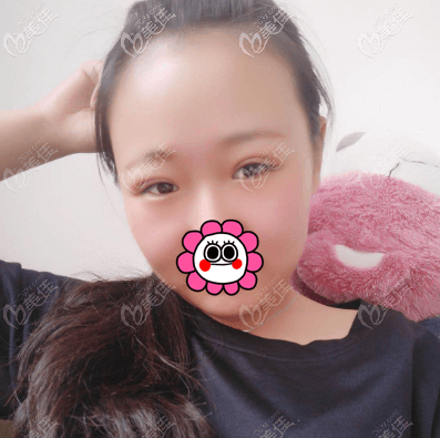 季一发给我做的埋线双眼皮没有出现眼皮一直发黑的情况