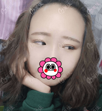 北京如朵埋线双眼皮