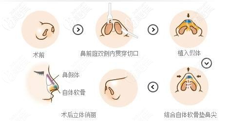 杨医生做鼻子整形的手术原理