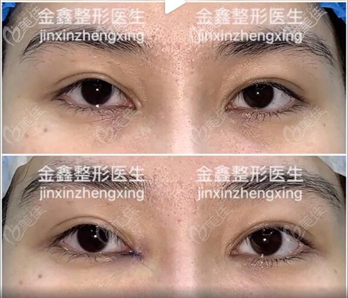 金鑫内眼角修复回包案例