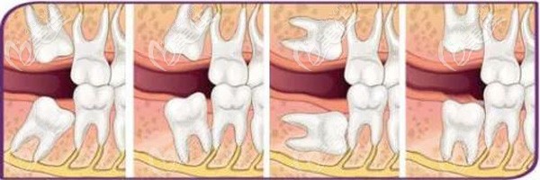 芜湖美臣口腔拔牙价格不会太高