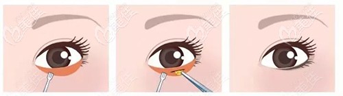 内切去眼袋过程