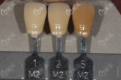 牙齿贴面2m2颜色图片 牙齿贴面2m2颜色图片