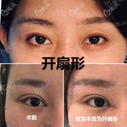 双眼皮外折平行改内折图片