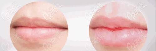 厦门脸博士乔雅登玻尿酸丰唇案例