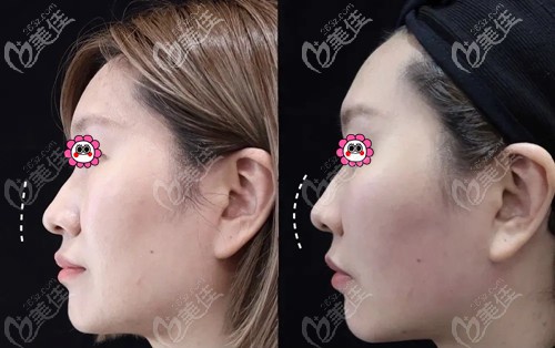 厦门脸博士乔雅登玻尿酸注射苹果肌