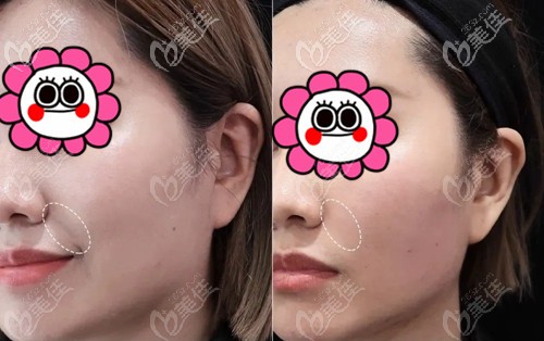 厦门脸博士乔雅登玻尿酸注射法令纹