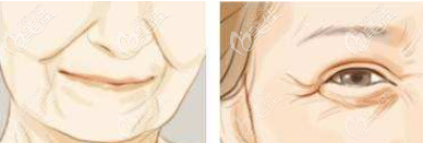 面部松弛下垂等示意图