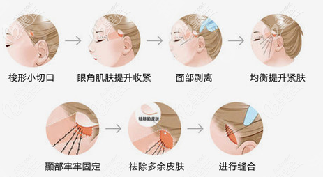 SMAS面部提升手术过程示意图