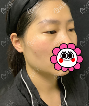 做定点双眼皮前 做定点双眼皮前