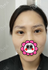 我做定点双眼皮有20多天了 我做定点双眼皮有20多天了