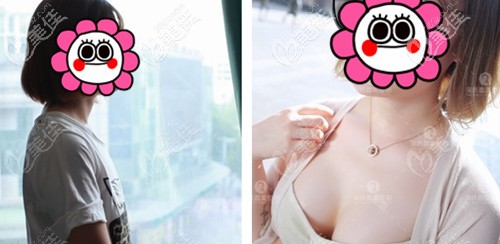 昆明吴氏嘉美脂肪丰胸案例