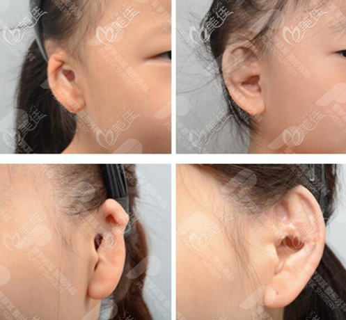 韩国普罗菲耳小耳畸形矫正实例图