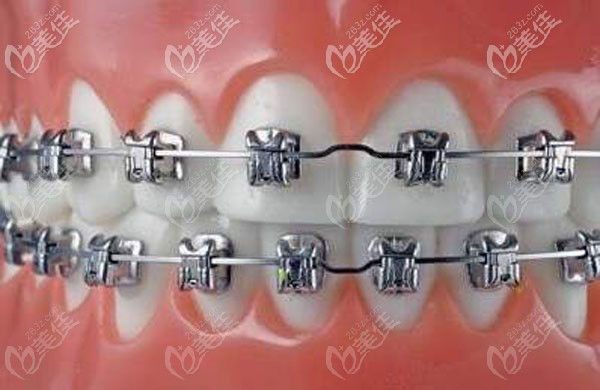 传统金属牙齿矫正