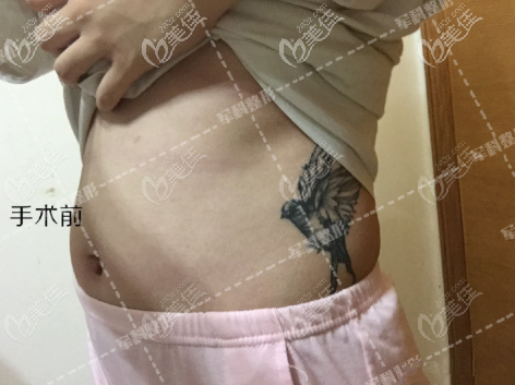 术前我的肚子 术前我的肚子