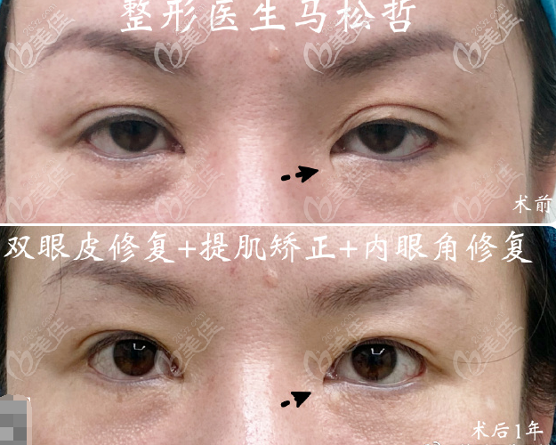 马松哲医生眼部修复案例 马松哲医生眼部修复案例