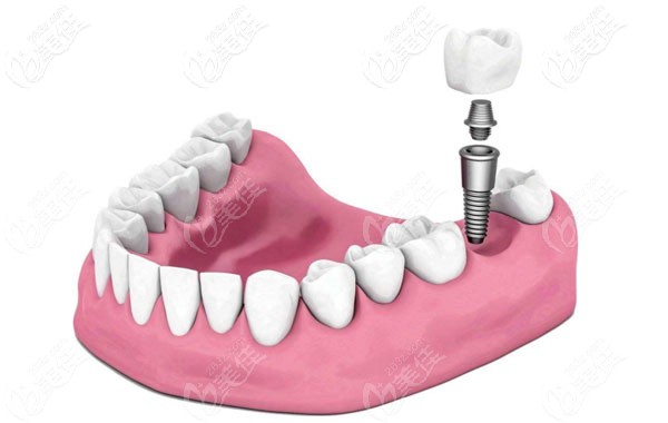 种植牙的效果怎么样