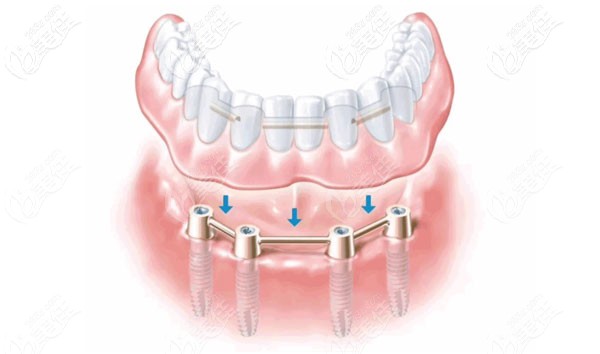 昆明雅度口腔的ALL-ON-4种植牙技术