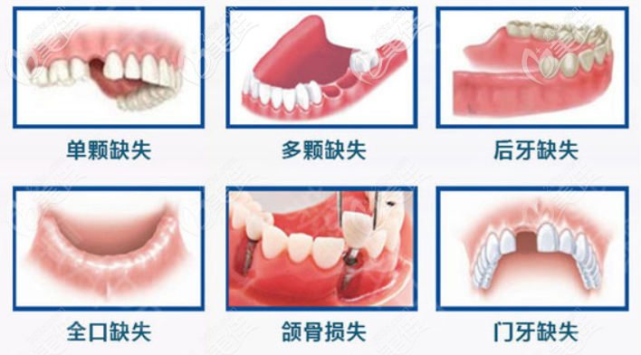 杭州临平城南口腔医院种植牙介绍