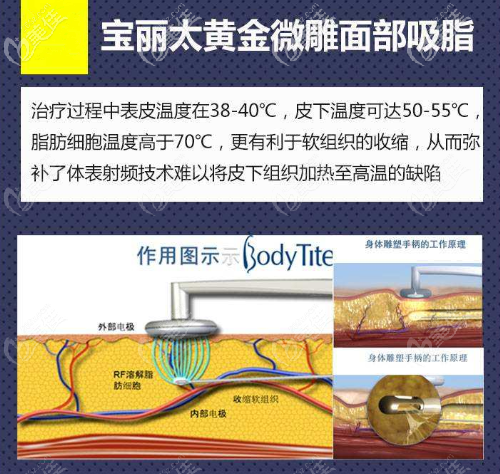 宝丽太射频溶脂 宝丽太射频溶脂