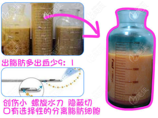 水动力吸脂的优势 水动力吸脂的优势