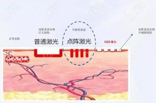 点阵激光与普通激光治疗对比