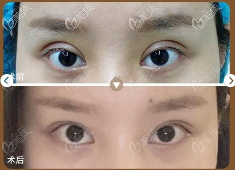 找的马松哲医生做的眼部修复案例 找的马松哲医生做的眼部修复案例
