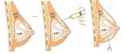 自体脂肪丰胸三次的效果