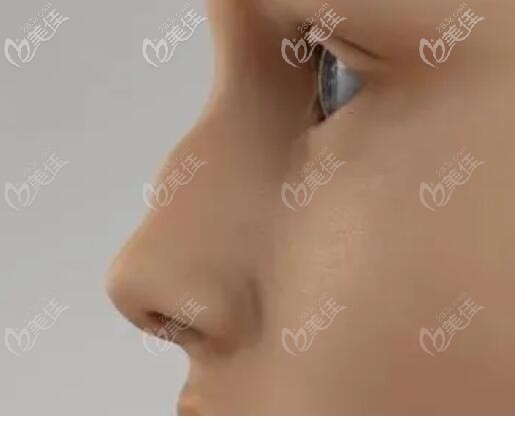 波浪鼻其实算是驼峰鼻的一种 波浪鼻其实算是驼峰鼻的一种