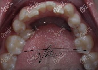 术前的龅牙也太丑了吧 术前的龅牙也太丑了吧