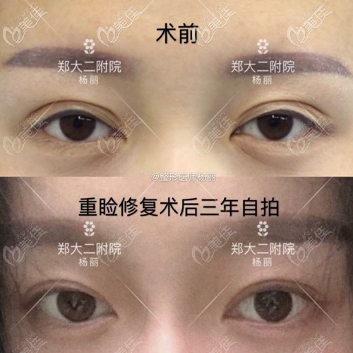 杨丽医生的双眼皮修复案例