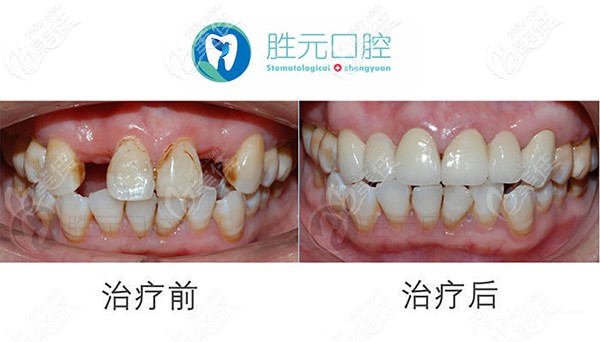 看看胜元口腔做种植牙怎么样